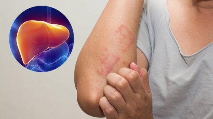 4 dấu hiệu chứng tỏ bệnh gan đã đi vào giai đoạn nặng: 1/4 cũng phải đi khám 4 dấu hiệu chứng tỏ bệnh gan đã đi vào giai đoạn nặng: 1/4 cũng phải đi khám