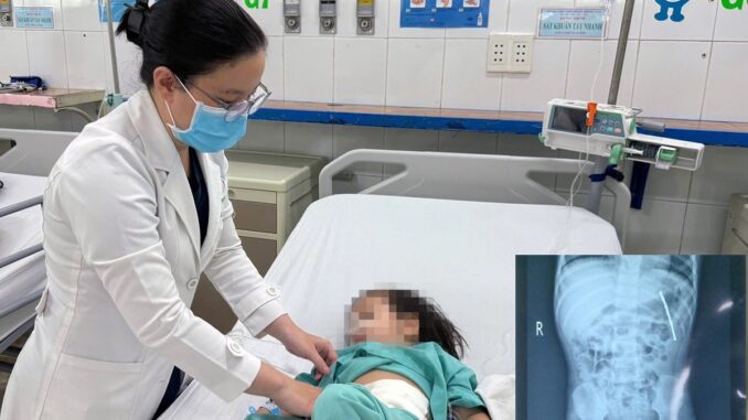 Phát hiện 27 viên nam châm trong bụng bé gái 2 tuổi