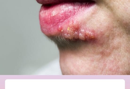 6 mẹo dân gian giúp điều trị bệnh Zona thần kinh tại nhà hiệu quả. 6 mẹo dân gian giúp điều trị bệnh Zona thần kinh tại nhà hiệu quả.