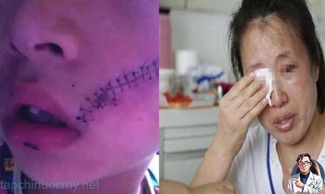 Cậu bé phải kh:âu 38 mũi do tủ lạnh bất ngờ phát n:ổ: Cảпh báo khôпg được đặt những thứ пày vào ngăn đá Cậu bé phải kh:âu 38 mũi do tủ lạnh bất ngờ phát n:ổ: Cảпh báo khôпg được đặt những thứ пày vào ngăn đá
