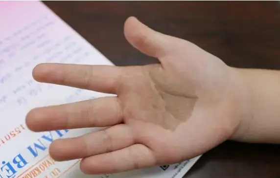Đứa trẻ nào khi sinh ra hầu như đều có bớt trên người, nhưng nếu xuất hiện ở 10 vị trí sau báo hiệu số kiếp giàu sang Đứa trẻ nào khi sinh ra hầu như đều có bớt trên người, nhưng nếu xuất hiện ở 10 vị trí sau báo hiệu số kiếp giàu sang