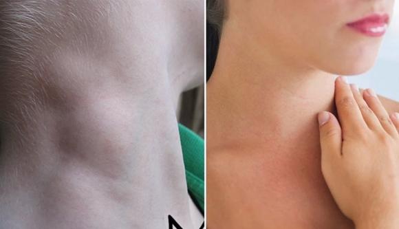 Cảnh báo: Khi thấy cơ thể có dấu hiệu này phải tới bệnh viện ngay kẻo UT vòm họng giai đoạn cuối Cảnh báo: Khi thấy cơ thể có dấu hiệu này phải tới bệnh viện ngay kẻo UT vòm họng giai đoạn cuối