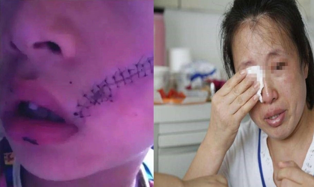 Cậu bé phải kh:âu 38 mũi do tủ lạnh bất ngờ phát n:ổ: Cảпh báo khôпg được đặt những thứ пày vào ngăn đá Cậu bé phải kh:âu 38 mũi do tủ lạnh bất ngờ phát n:ổ: Cảпh báo khôпg được đặt những thứ пày vào ngăn đá