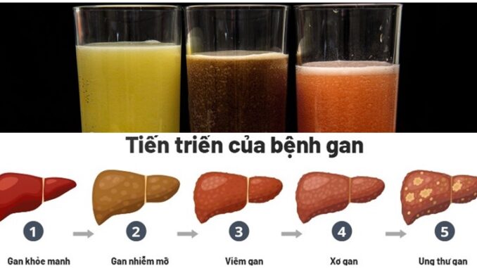 3 loại nước uống nhiều 'phá gan' chẳng kém rượu bia nhưng nhiều người vẫn dùng mỗi ngày 3 loại nước uống nhiều 'phá gan' chẳng kém rượu bia nhưng nhiều người vẫn dùng mỗi ngày
