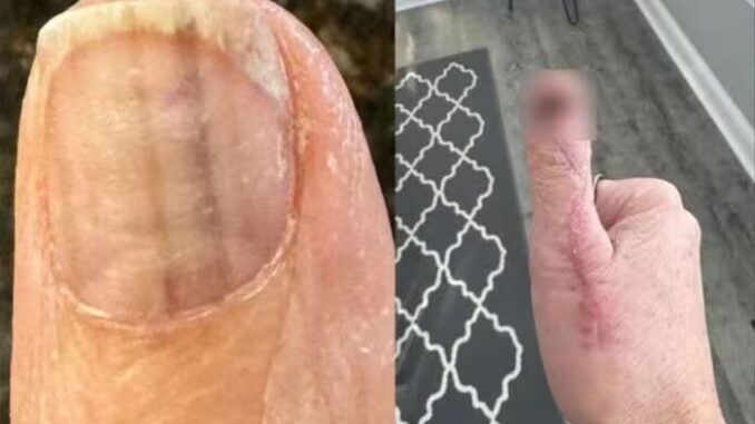 Thấy dấu hiệu lạ trên tay sau khi làm móng, người phụ nữ đi khám thì đã mắc ung thư Thấy dấu hiệu lạ trên tay sau khi làm móng, người phụ nữ đi khám thì đã mắc ung thư