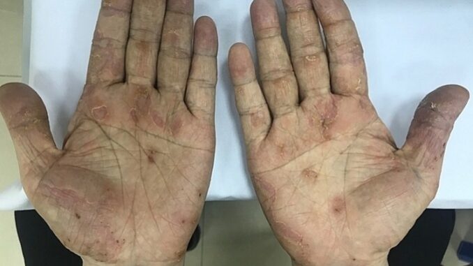 Hàng chục nghìn người nhiễm giun đũa chó mèo mỗi năm, nguyên nhân do đâu Hàng chục nghìn người nhiễm giun đũa chó mèo mỗi năm, nguyên nhân do đâu