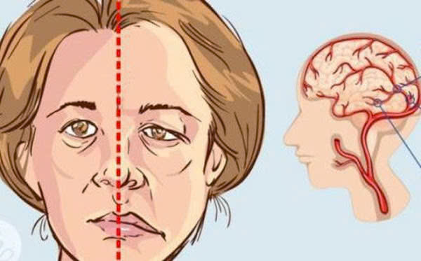 Đột quỵ đang tăng ở người trẻ: 4 dấu hiệu khi ngủ báo trước đột quỵ, cần đi viện chứ đừng cố ngủ tiếp Đột quỵ đang tăng ở người trẻ: 4 dấu hiệu khi ngủ báo trước đột quỵ, cần đi viện chứ đừng cố ngủ tiếp