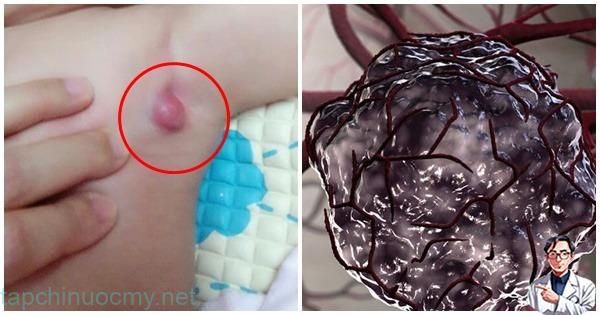 9 triệu chứng ‘điển hình’ báo hiệu trẻ nhỏ bị un g thư giai đoạn đầu: Mẹ đưa con đến viện ngay 9 triệu chứng ‘điển hình’ báo hiệu trẻ nhỏ bị un g thư giai đoạn đầu: Mẹ đưa con đến viện ngay