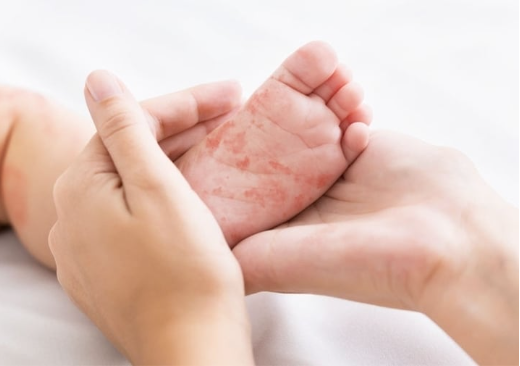 Bé gái 4 tuổi không tiêm vaccine phòng sởi đã t u v ong Bé gái 4 tuổi không tiêm vaccine phòng sởi đã t u v ong