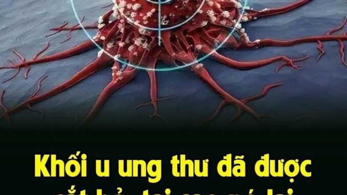 Khối u ᴜng thư đã được cắt bỏ, tại sao nó lại tái phát? Khối u ᴜng thư đã được cắt bỏ, tại sao nó lại tái phát?