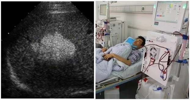 Thanh niên 26t ung thư gan dù không rượu bia, BS nói 2 thói quen ăn uống còn độc hại hơn: Ai có bỏ ngay Thanh niên 26t ung thư gan dù không rượu bia, BS nói 2 thói quen ăn uống còn độc hại hơn: Ai có bỏ ngay