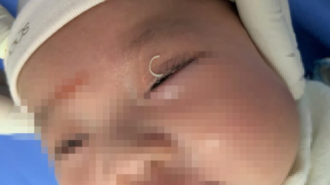 Mẹ cắt móng tay văng vào mắt, cháu bé 2 tháng tuổi lâm nguy Mẹ cắt móng tay văng vào mắt, cháu bé 2 tháng tuổi lâm nguy