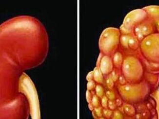Những dấu hiệu âm thầm của u-ng thư thận dễ bị bỏ qua