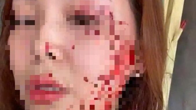 Một phụ nữ ở Nha Trang tố cáo ‘bị người không quen biết rạch mặt’ Một phụ nữ ở Nha Trang tố cáo ‘bị người không quen biết rạch mặt’
