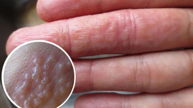 Tay mọc mụn nước li ti có sao không? Tay mọc mụn nước li ti có sao không?